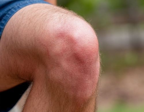 Гонартроз коленного сустава: как вернуть подвижность и победить боль